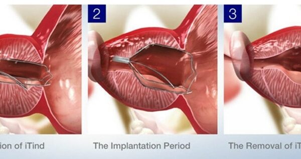 Revolutionary iTIND Solution for Urinary Issues in Youth at AINU